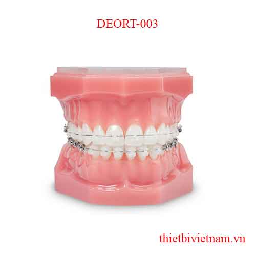 CERAMIC BRACKETS TUBES ARE METAL AND WIRES ARE MADE WITH WHITE COATED NITI WIRE DEORT-003