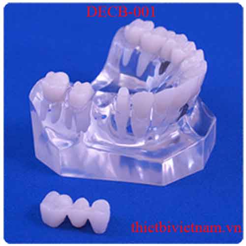 DECB-001 SINGLE TOOTH MISSING IMPLANT VS BRIDGE