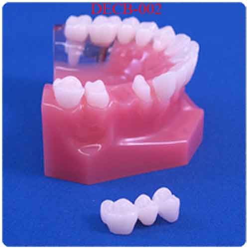 DECB-002 INTERMEDIARY DEFECT IMPLANT (W/TRANSPARENT WINDOW) VS BRIDGE