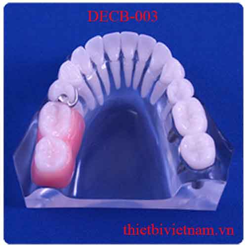 DECB-003 FREE-END DEFECT IMPLANT VS PARTIAL DENTURE