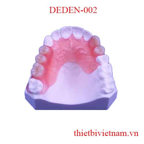 DEDEN-002 MAXILLARY NON-CLASP DENTURE