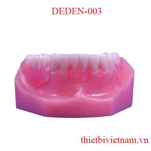 DEDEN-003 MANDIBULAR NON-CLASP DENTURE
