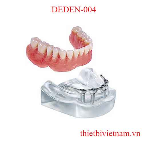 DEDEN-004 IMPLANT OVERDENTURES- HADER BAR
