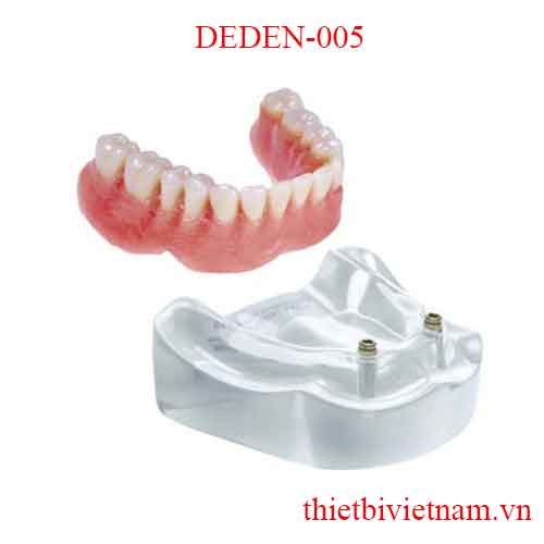 DEDEN-005 IMPLANT OVERDENTURES-LOCATOR