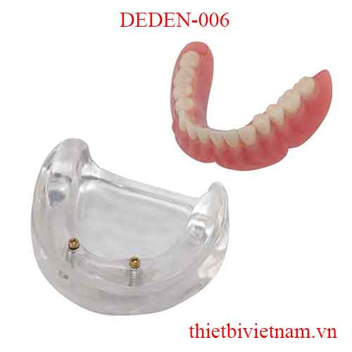 DEDEN-006 IMPLANT OVERDENTURES-ZEST ABUTMENTS
