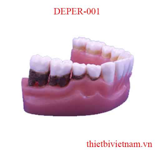 DEPER-001 2X NATURAL-SIZE LOWER JAW MODEL WITH PERIODONTAL DISEASE