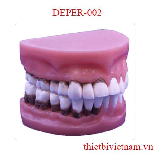 DEPER-002 2X NATURAL-SIZE PERIO DONTAL DISEASE DEMONSTRATION MODEL