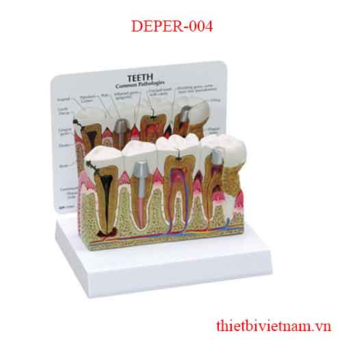 DEPER-004 PERIO DONTAL DISEASE AND TOOTH DISEASE MODEL