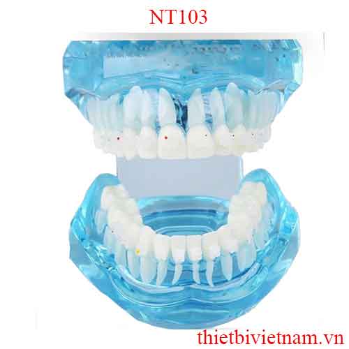 MẪU HÀM TƯ VẤN CHỈNH NHA MẮC CÀI SỨ NT103
