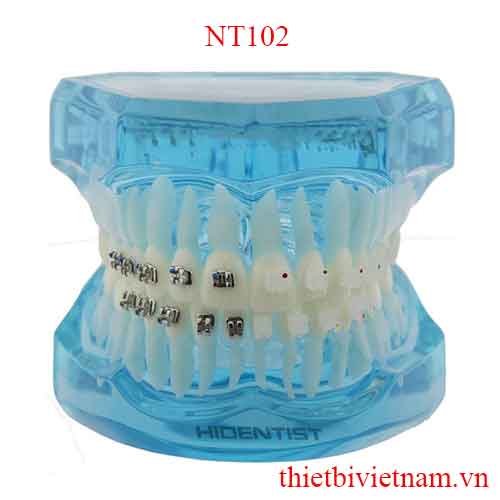 MẪU HÀM TƯ VẤN CHỈNH NHA MẮC CÀI SỨ VÀ KIM LOẠI NT102