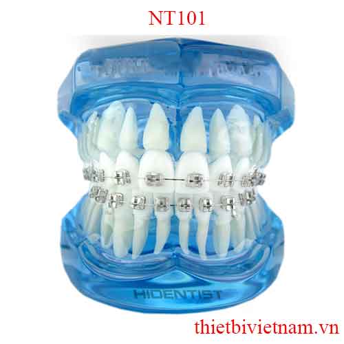 MẪU KÀM TƯ VẤN CHỈNH NHA MẮC CÀI KIM LOẠI NT101