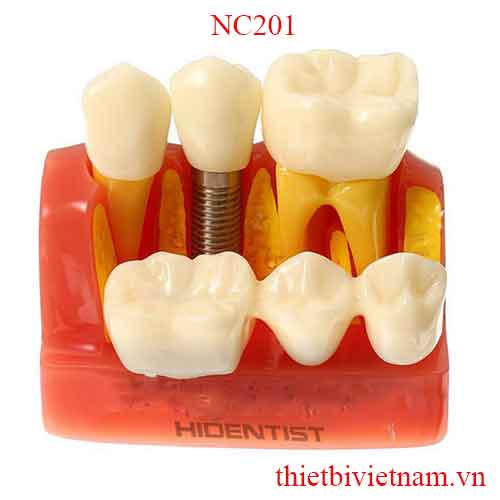 MÔ HÌNH TƯ VẤN IMPLANT VÀ CẦU RĂNG NC201
